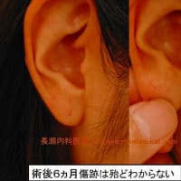 粉瘤　耳（耳たぶ）の炎症性粉瘤
