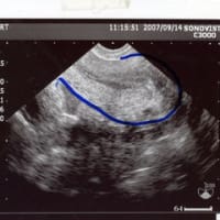 子宮内膜ポリープのエコー写真