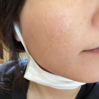 月1のセルフハーブピーリング