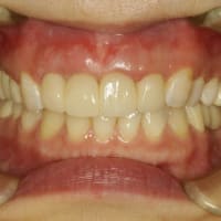前歯の差し歯の周りの歯茎が黒く見えて気になるってことはありませんか？