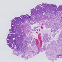 十二指腸の小腸型腺腫,SNADET, small-intestinal type adenoma of duodenum
