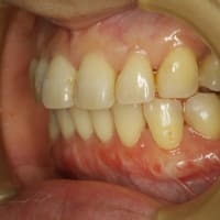 矯正治療後の歯茎の退縮には歯茎の再生治療が有効です。