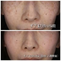 ダブルフラクショナル受けました！