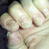 荒れる 手のひら 手や指の皮がボロボロむける５つ原因と対策！病気の可能性もあり？