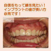 インプラントの歯茎再生で気にしていた歯茎の黒ずみや、セラミックの歯が長く見える悩みが解決したケースをご紹介します。