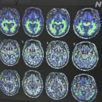 パーキンソン病などの患者の脳に蓄積する異常なたんぱく質を、生きている患者の脳内で撮影することに成功したと量子科学技術研究開発機構などのグループが発表