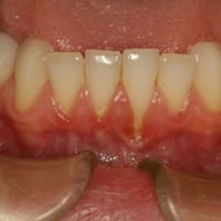 歯茎が下がったところには歯石がつきやすくなる場合があります。