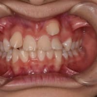 長期間かかった抜歯矯正例