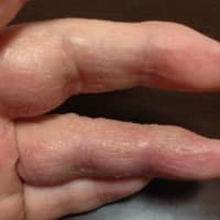 手の毒だし 第2弾
