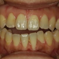 歯茎が下がってしまっている方の矯正治療　増骨矯正法　PAOO