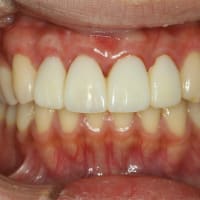 歯茎が下がってしまったときの歯茎の再生処置　