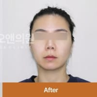 【韓国美容】日本では体験できない変化？ON医院で受けたチタニウムのビフォーアフター✨