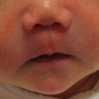 乳児湿疹画像記録