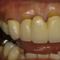 若いころに入れた前歯のセラミックが古くなって歯茎が下がってしまって、息が漏れたり、歯茎が黒くなったりしていませんか？