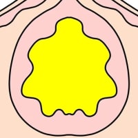 粉瘤の家系