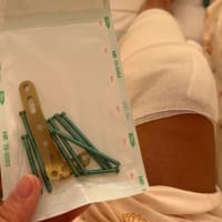 続７~脛骨高原骨折した理容師のけがから1年後・・・
