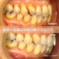 歯茎の退縮は早期治療が大切です。