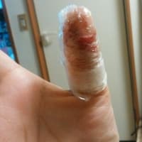 包丁で指を切りまして1 湿潤療法やってみた ひぐらしの思い出