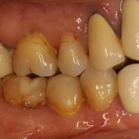 あなたの差し歯は長くなってしまっていませんか？　歯茎を回復させる歯茎の再生治療のご紹介