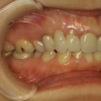 要注意です。歯を抜いた後にブリッジ治療をする場合、歯茎が下がって歯が長くなってしまう事があります。お勧めの審美歯科治療