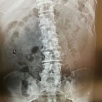 脊柱管狭窄症について