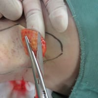 名古屋栄の「にしやま形成外科皮フ科クリニック」で腋臭、わきがの手術