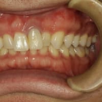 長い差し歯の治療　〜ピンクの歯茎のついたセラミックにならない治療法〜