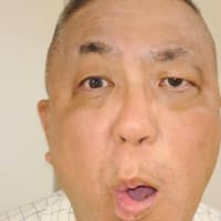完治症例　重度顔面神経麻痺6０代男性　佐山様