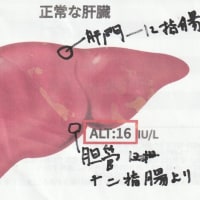 胆管がん