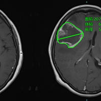 希少がんである神経膠腫の画像評価精度を向上させるAI技術