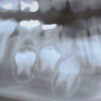 お子さんの歯が抜けたのに、永久歯がすぐに生えてこないのは、なぜ？