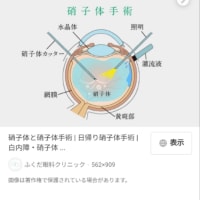 網膜剥離再再々手術かも