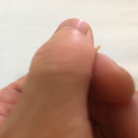 お灸について