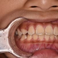 口腔機能に影響ある噛み合わせ