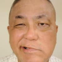 完治症例　重度顔面神経麻痺6０代男性　佐山様