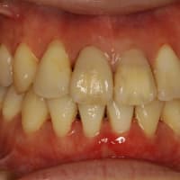 矯正後に歯茎が下がってしまうことがあります。特に下の前歯の歯茎が下がってしまうことがあります。