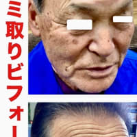 シミ取りビフォーアフター★ついでに若返り