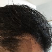 植毛後10ヶ月