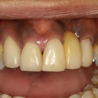 歯茎が黒い場合も歯茎の再生治療が有効です。