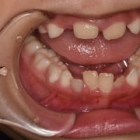 永久歯反対（交叉）咬合の早期アプローチ