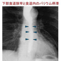 多系統萎縮症における胸のつかえ，嘔吐の原因 ―遠位食道痙攣（distal esophageal spasm）の発見―