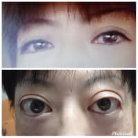 バセドウ病眼症