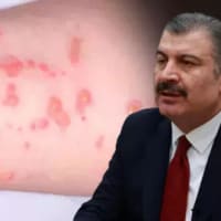 トルコで５人のサル痘感染が見つかった