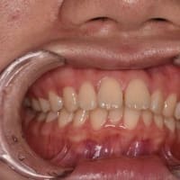 抜歯矯正の抜歯部位診断の根拠