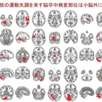 なぜ小脳の脳梗塞でなくても四肢の（小脳性）運動失調が生じるのか？