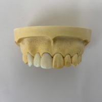 仮歯製作その２