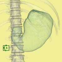 CT Gastrography (CTで胃をみる２)    