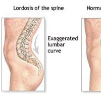 腰部脊柱管狭窄症(ＬＳＳ)について（勉強会）