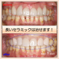 歯茎が下がって長くなったセラミックを短くする方法