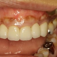 あなたの前歯のブリッジは長さがそろっていますか？　ブリッジの長さをそろえる歯科治療法